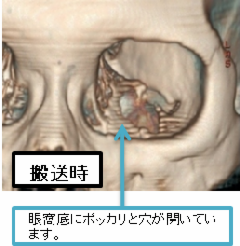 骨折 眼窩